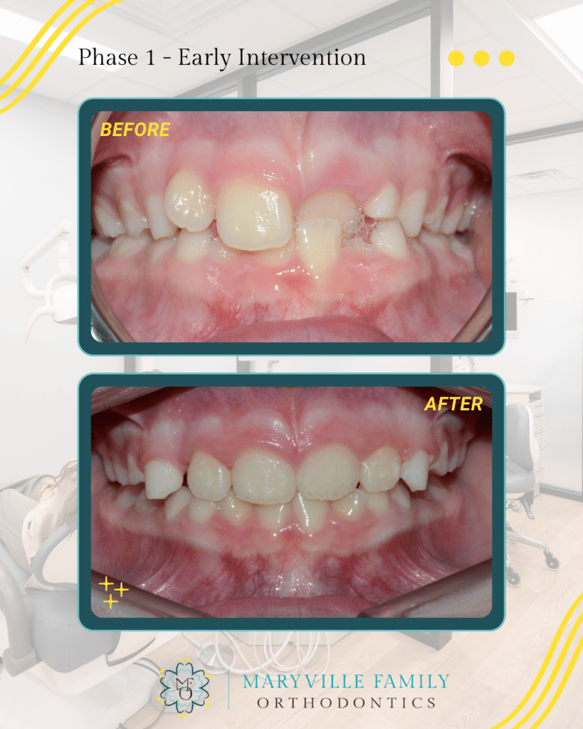 To images showing before/after Phase I orthodontic treatment for a case with an anterior crossbite