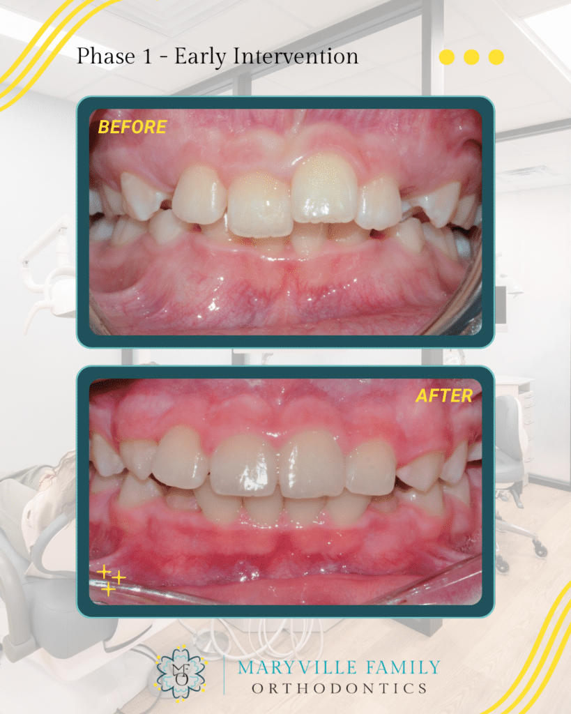 Two images showing before/after a Phase I orthodontic treatment case that had upper crowding and misalignment.