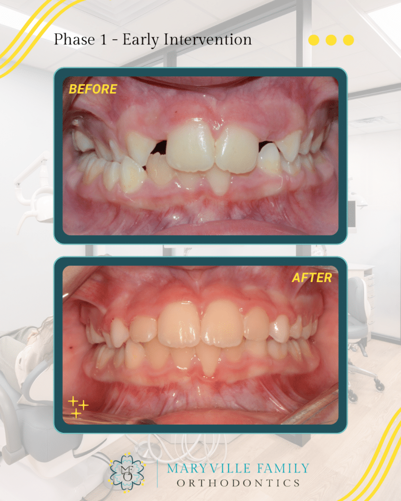 Two images showing before/after a Phase I orthodontic treatment case with crowding, a crossbite, and delayed eruption of upper lateral incisors.