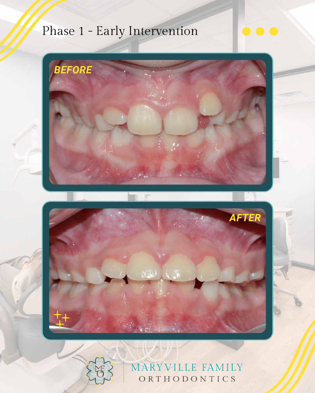 Two images showing before/after a Phase I orthodontic treatment case with misaligned upper teeth and an upper later coming in through the gums.