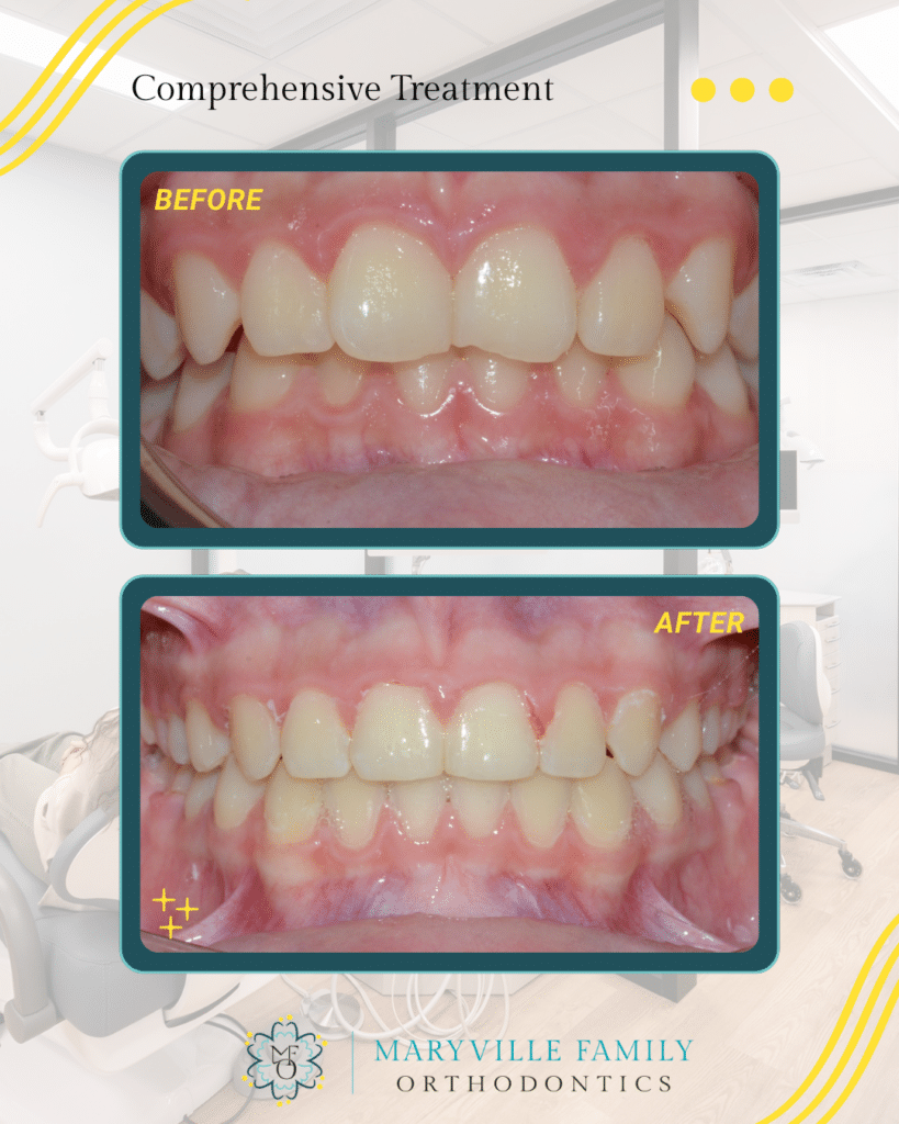 Two images showing before/after a comprehensive orthodontic treatment case with dental crowding.