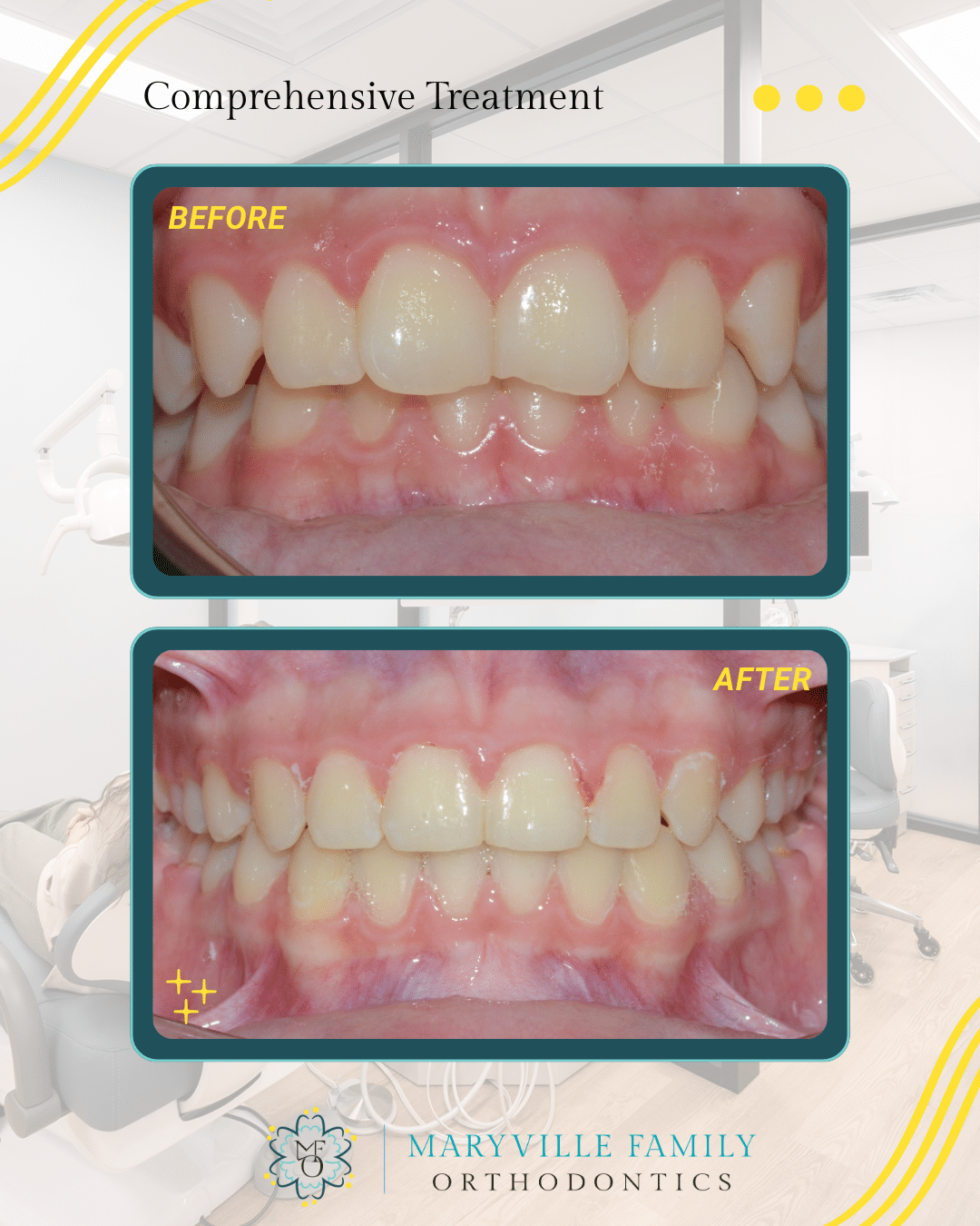 Two images showing before/after a comprehensive orthodontic treatment case with dental crowding.